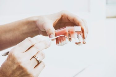 dental implants Hervey Bay